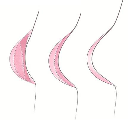 Trulife Recover Shell Breast Prothesis